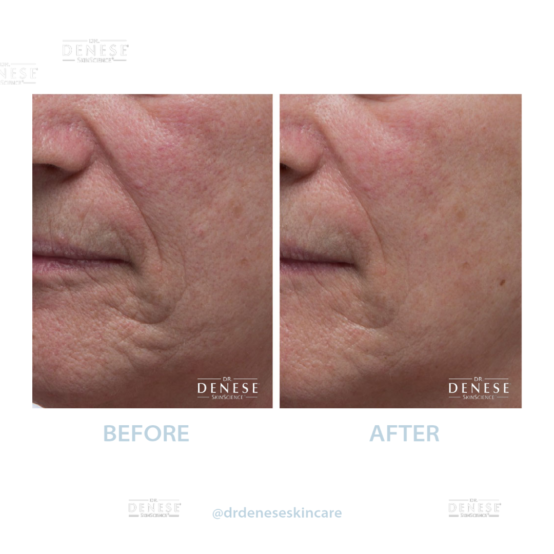 Dr. Denese Collagen Firming Peel Off Mask