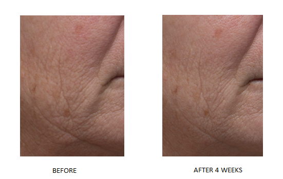 Dr. Denese Triple Strength Wrinkle Smoother Advanced Treatment